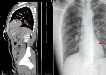 Acude al hospital por un dolor al orinar y los médicos encuentran algo inquietante en su cuerpo