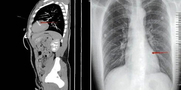 Acude al hospital por un dolor al orinar y los médicos encuentran algo inquietante en su cuerpo