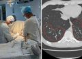 Hombre muere con los pulmones destruidos tras 17 años fumando vapeadores y narguiles