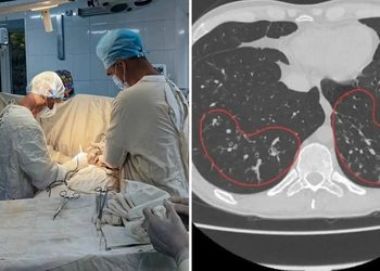 Hombre muere con los pulmones destruidos tras 17 años fumando vapeadores y narguiles